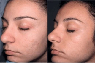 Before & After Derma Rollers Treatment
