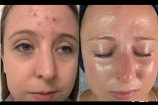 Before & After Dermapen Treatment in Dubai