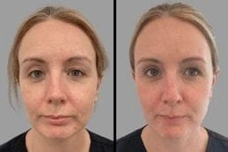 Before & After Derpamen Treatment in Dubai