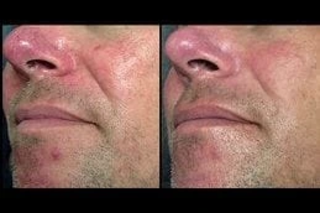 Facial Capillaries Treatment 4 Before & After Facial Capillary Treatment Dubai