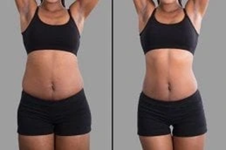 Laser Fat Reduction 4 Before & After Fat Reduction