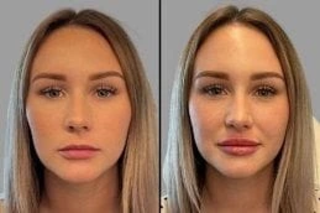 Fotona 4D Lip Augmentation 4 Before & After Fotona 4D Lip Augmentation