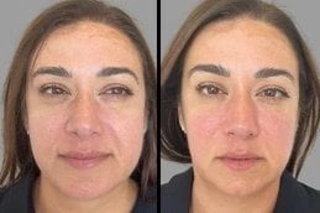 Before & After Hydrafacial in Dubai