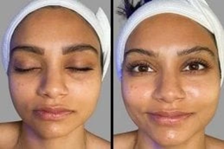 Before & After Hydrafacial