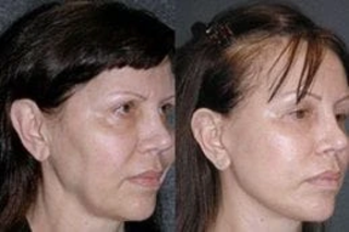 Before & After J-Plasma Skin Resurfacing in Dubai