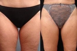 J plasma for Thighs & Arms 1 Before & After J plasma for Thighs & Arms Treatment in Dubai