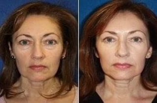 Laser Photo Rejuvenation 4 Before & After Laser Photo Rejuvenation in Dubai