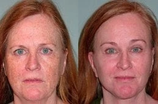Laser Photo Rejuvenation 6 Before & After Laser Photo-Rejuvenation