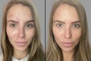 Before & After Laser Treatment for Face in Dubai