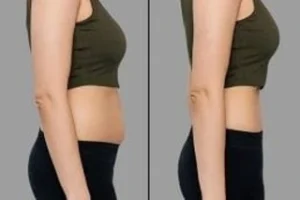 Before & After Liposonix Treatment