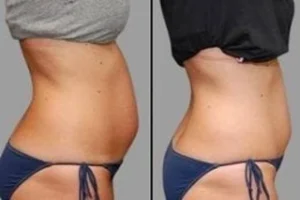 Before & After Liposonix Treatment in Dubai