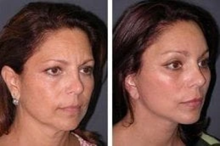 Before & After MESOGOLD Stamp Therapy in Dubai