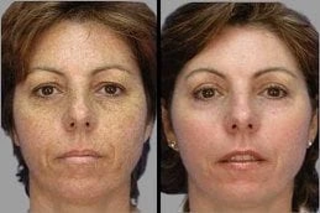Microdermabrasion 4 Before & After Microdermabrasion in Dubai