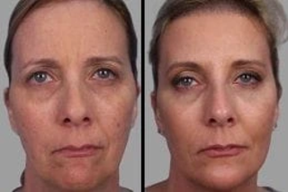 Microdermabrasion 6 Before & After Microdermabrasion