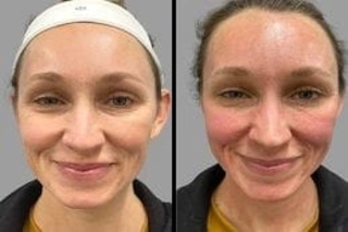 Before & After Microneedling in Dubai