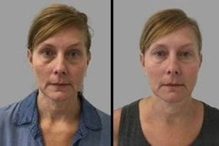 Before & After Microneedling