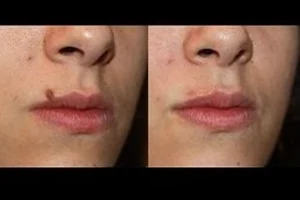 Before & After Mole Removal in Dubai
