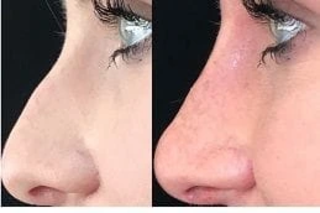 Before & After Non Surgical Nose Job in Dubai