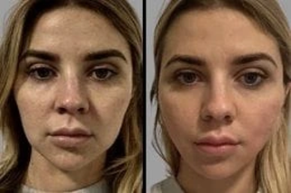 Before & After PDO Mono Threads