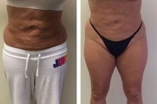 Proellixe Vibration Therapy 4 Before & After Proellixe Vibration Therapy in Dubai
