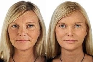 Before & After Profhilo Treatment in Dubai