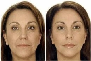 Before & After Profhilo Treatment