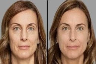Redermalization Treatment 4 Before & After Redermalization Treatment