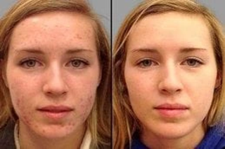 Rosacea Treatment 5 Before & After Rosacea Treatment