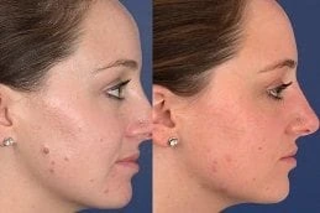 Before & After Skin Lesion Removal Treatment in Dubai