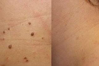 Before & After Skin Lesion Removal Treatment