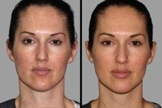 Skin Rejuvenation 5 Before & After Skin Rejuvenation in Dubai