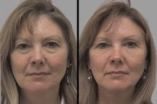 Skin Rejuvenation 4 Before & After Skin Rejuvenation