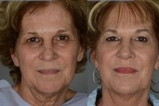 Laser Skin Resurfacing 3 Before & After Skin Resurfacing in Dubai