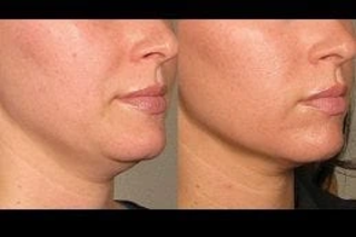 Skin Tightening and Contouring 4 Before & After Skin Tightening and Contouring Treatment in Dubai