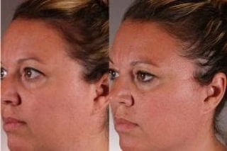 Skin Tightening and Contouring 6 Before & After Skin Tightening and Contouring Treatment