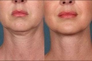 Skin Toning Treatment 1 Before & After Skin Toning Treatment in Dubai
