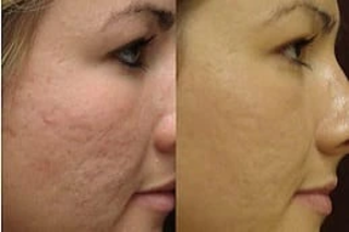 Before & After Subcision Treatment for Acne Scars in Dubai
