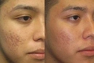 Before & After Subcision Treatment for Acne Scars