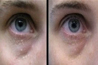 Syringoma Removal Treatment 5 Before & After Syringoma Removal in Dubai