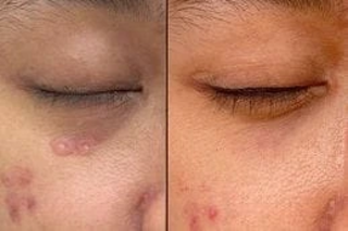 Syringoma Removal Treatment 6 Before & After Syringoma Removal