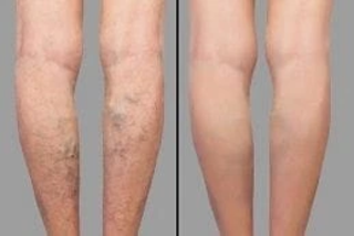 Varicose Veins Treatment 4 Before & After Varicose Veins Treatment