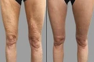 Before & After Velashape 3 Treatment in Dubai