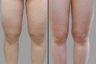Before & After Velashape 3 Treatment