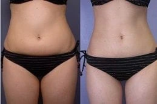 Laser Liposuction 4 Before & After laser liposuction in dubai