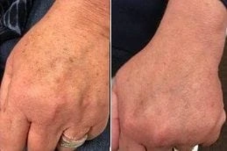 Before And After Evo Laser in Dubai