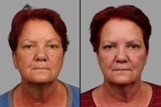 Enlighten Pico Genesis 4 Before and After Enlighten Pico Genesis