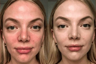 Fotona 4D For Face 4 Before and After Fotona 4D For Face