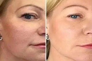 Before and After Plasma Pen