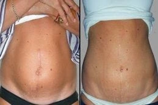 Post Surgical Scars 4 Before and After Post Surgical Scar in Dubai