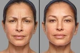 Radio Frequency Treatment 4 Before and After Radio Frequency Treatment in Dubai